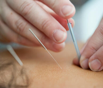 Acupuncture